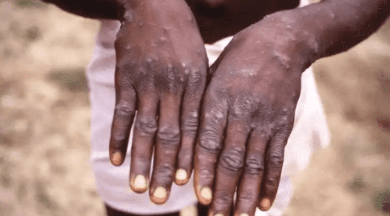 Monkeypox: NCDC registers 15 new cases