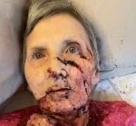 76yrs old woman badly injured by a huge rat while she was asleep