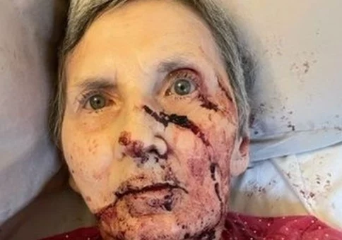 76yrs old woman badly injured by a huge rat while she was asleep