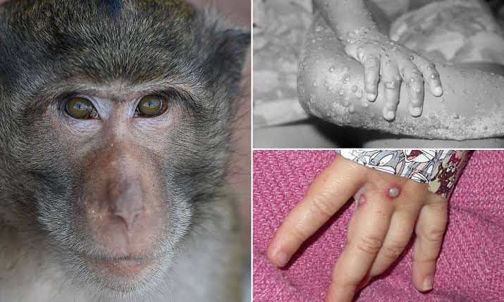 NCDC: Monkeypox cases confirmed in Nigeria