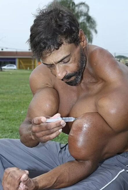 Popular Brazilian Hulk bodybuilder dies after injecting his enormous biceps