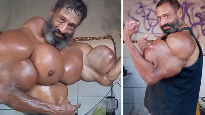Popular Brazilian Hulk bodybuilder dies after injecting his enormous biceps