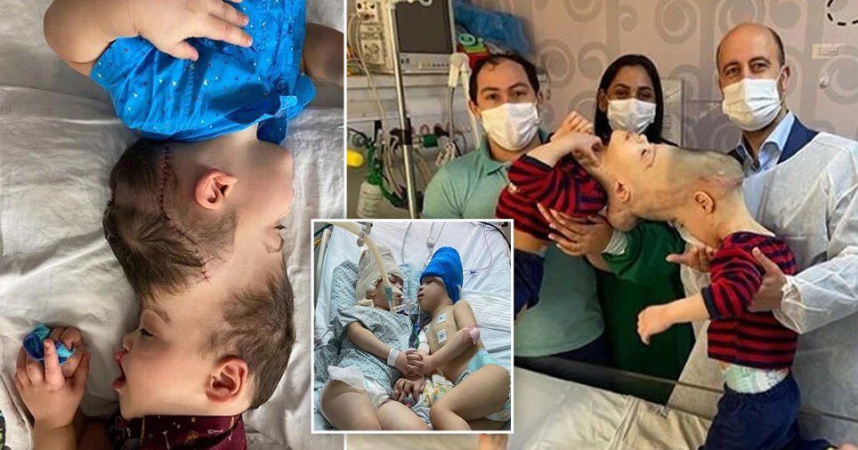 Photos: Conjoined twins with 'Fused Brains' separated through surgery in Brazil