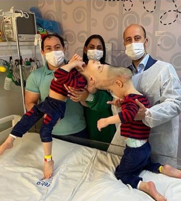 Photos: Conjoined twins with 'Fused Brains' separated through surgery in Brazil