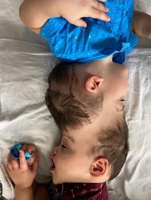 Photos: Conjoined twins with 'Fused Brains' separated through surgery in Brazil