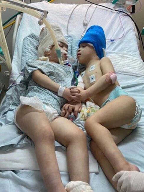 Photos: Conjoined twins with 'Fused Brains' separated through surgery in Brazil