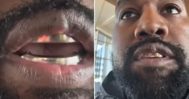 Kanye West’s bulbous lip sparks concern with alarming ‘growth’ weeks after experimental treatment