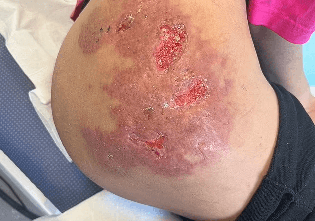 Woman calls for ban on 'liquid BBLs' after botched procedure left her with leaking black holes from her buttocks (Photos)