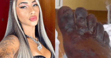 Influencer may never be able to walk again after taking part in online “challenge” that turned her feet black